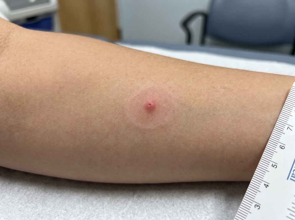 Close-up photograph of a fresh red spider bite mark on skin showing mild swelling and two faint puncture points