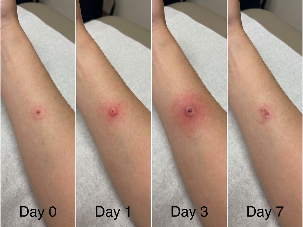 Four panel progression photograph of a healing spider bite on day zero, day one, day three, and day seven